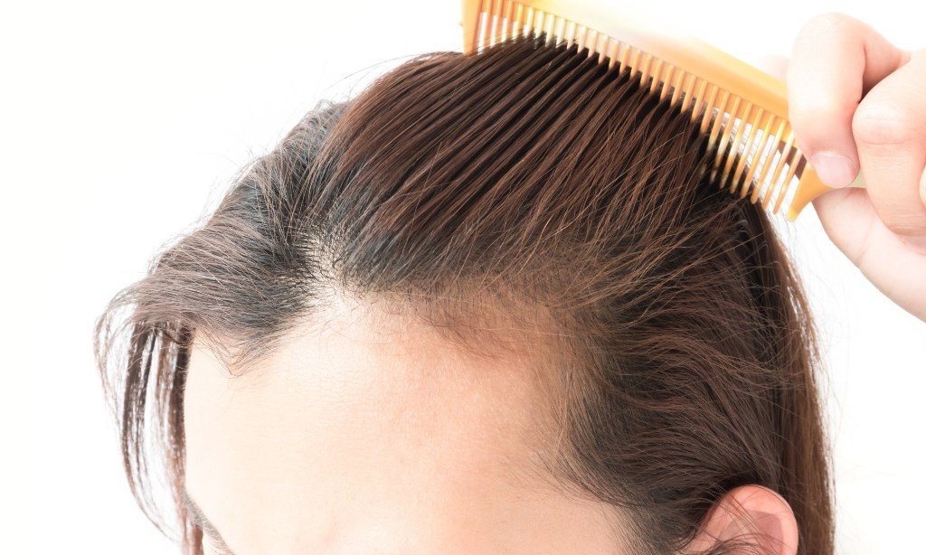 Hair Loss Treatment