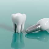 Dental Implants 2