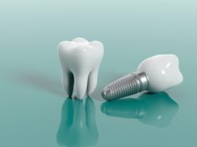 Dental Implants 2