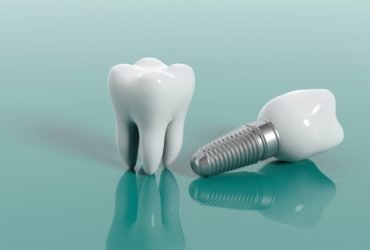 Dental Implants 2